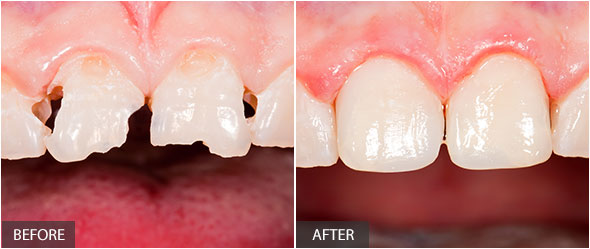 Frontal teeth after restoration
