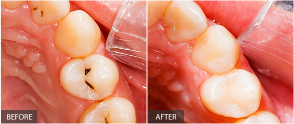 Teeth  treatment - dental composite filling