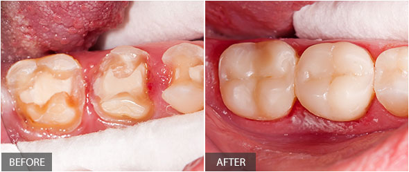 Tooth restoration dental treatment