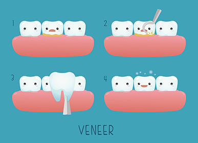Veneer tooth of dental