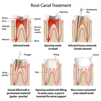 root_canal_therapy_restorations