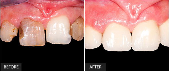 Frontal teeth restoration with ceramic crowns