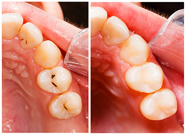 Teeth before and after treatment - dental composite filling