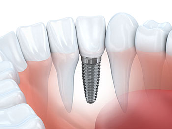 crowns_onlays_dental_implants