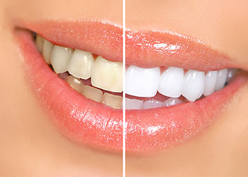 tooth whitening