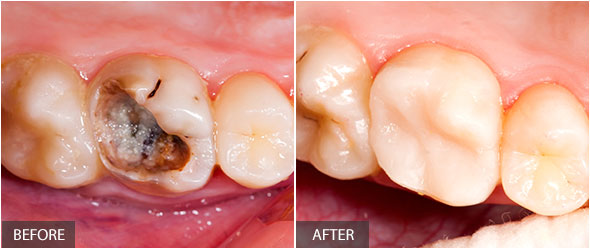 Decayed tooth after restorative treatment